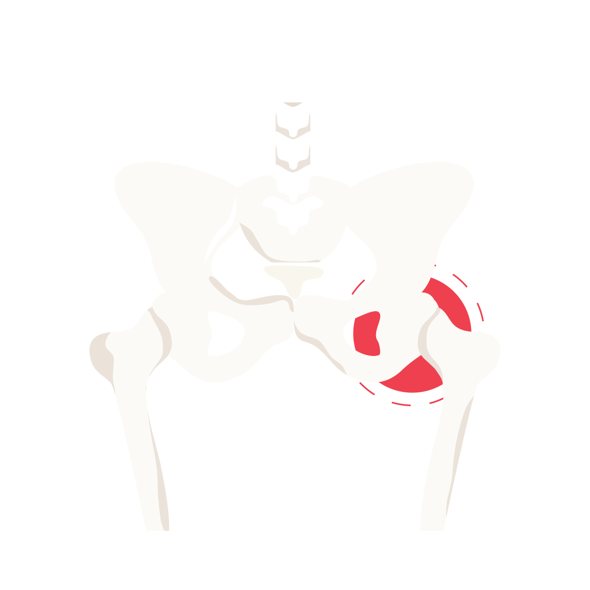 a CGI artistic rendering of a pair of hips with a small ring of pain
